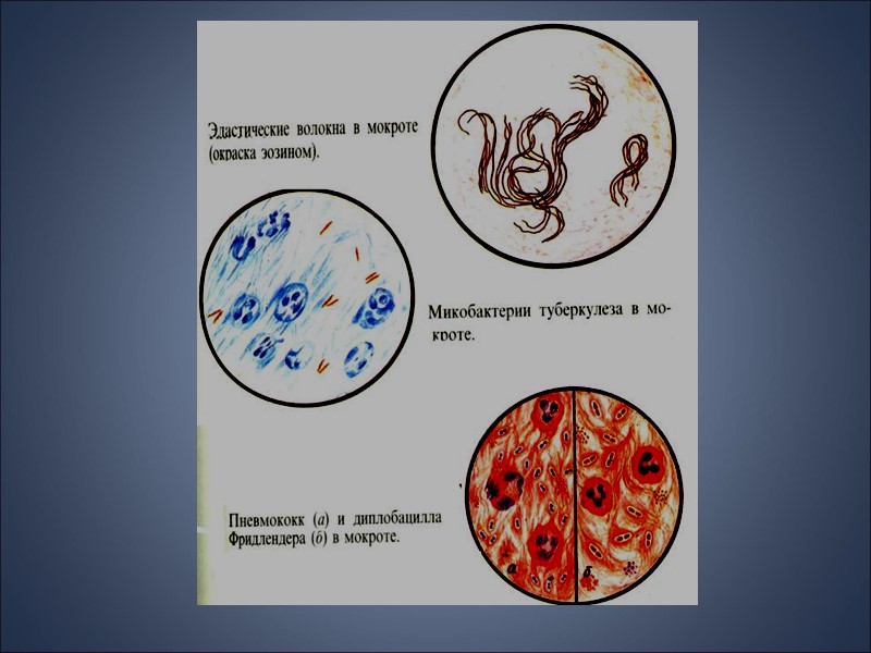 МИКРОСКОПИЧЕСКОЕ ИССЛЕДОВАНИЕ Макрофаги- встречаются при различных воспалительных процессах в бронхах и легочной ткани Сидерофаги